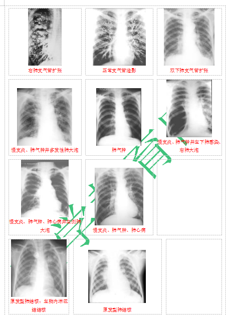 快收藏！臨床助理醫(yī)師實(shí)踐技能62個(gè)胸片（圖片診斷）