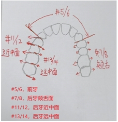 齦下刮治術