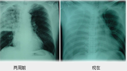 肺炎